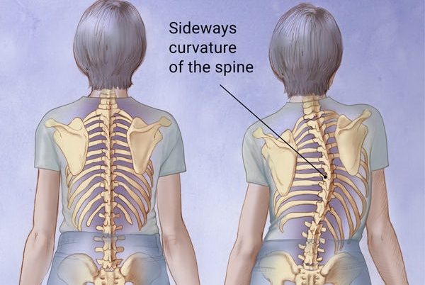 اسکولیوزیس
